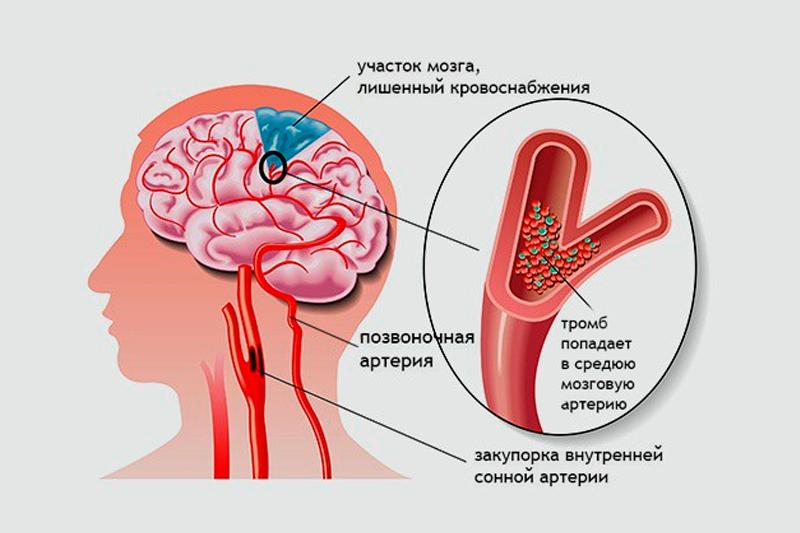 Хроническая ишемия головного мозга