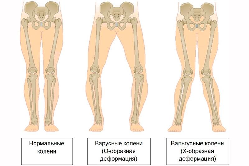 Искривление голеней