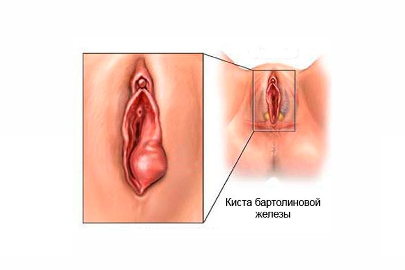 Киста бартолиновой железы Киста бартолиновой железы