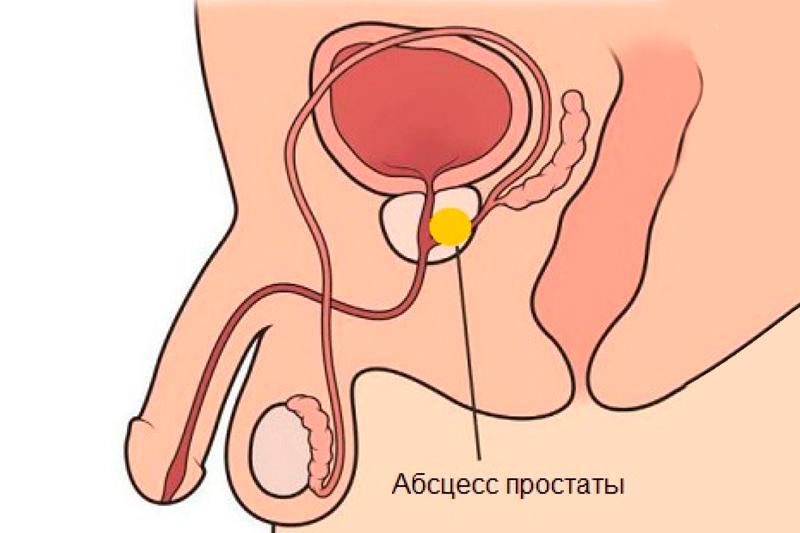 Абсцесс предстательной железы Абсцесс предстательной железы
