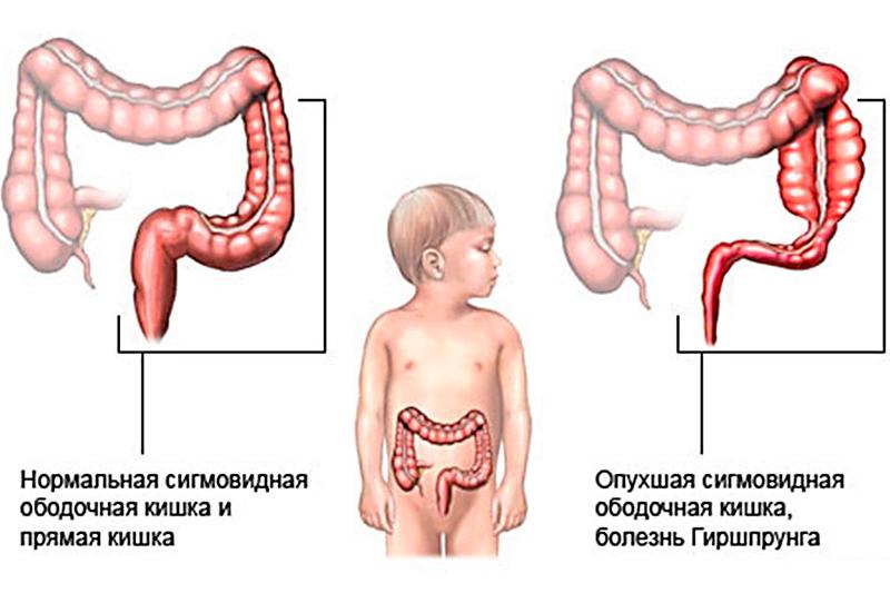 Болезнь Гиршпрунга Болезнь Гиршпрунга