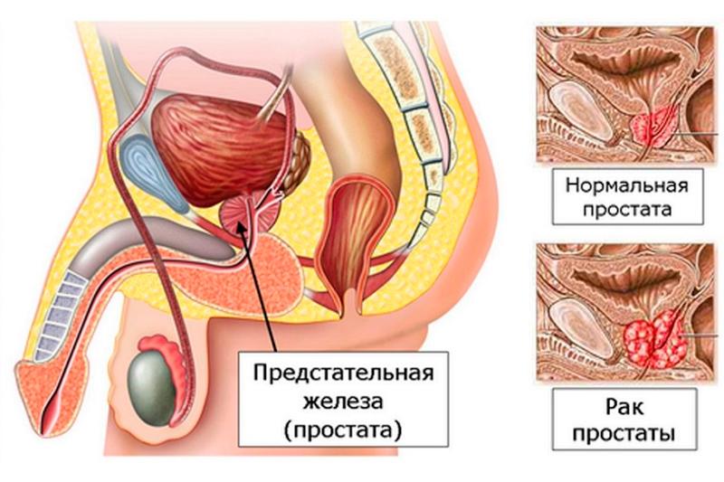 Рак простаты