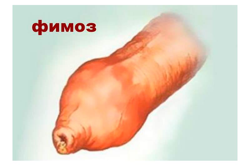 Фимоз Фимоз