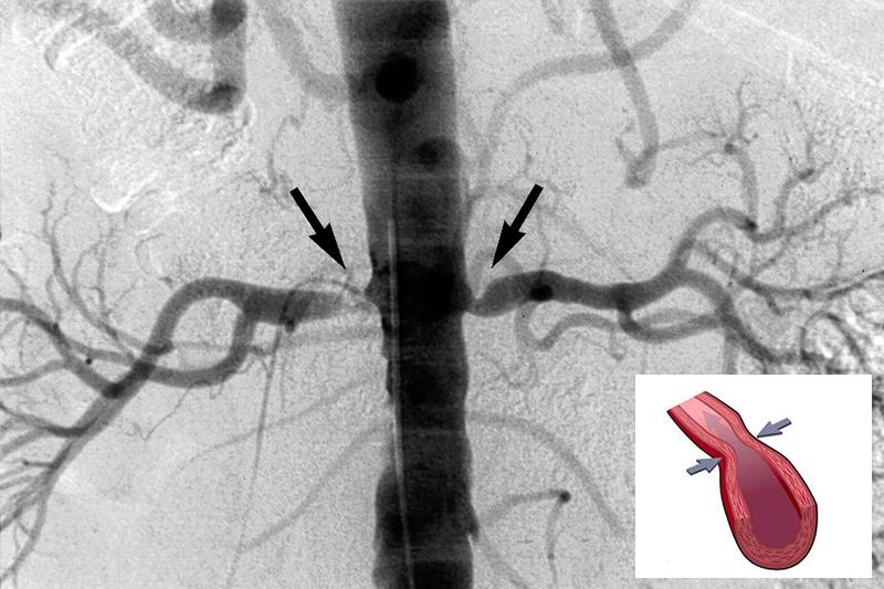 Стеноз почечной артерии