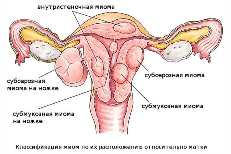 Подсерозная фиброма матки