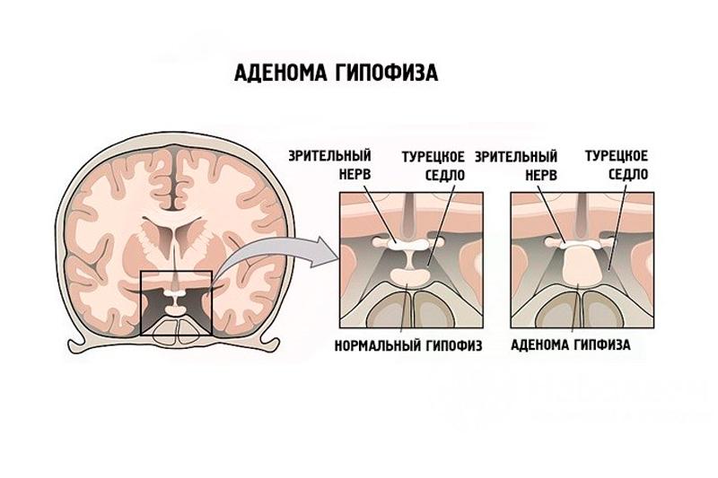 Аденома гипофиза Аденома гипофиза
